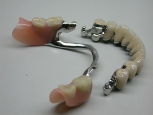 бюгельное протезирование зубов